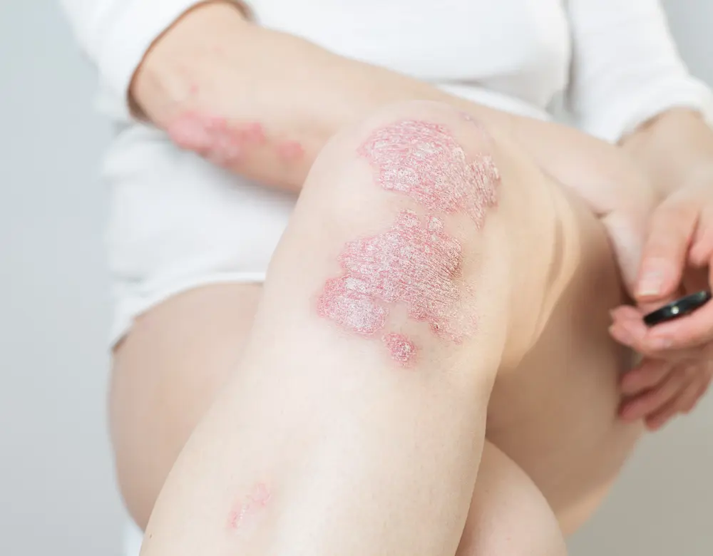 Hyaluron und Filler bei Mutter und Tochter