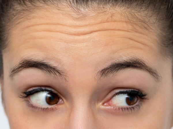 Stirnfalten Faltenbehandlung - Bild von Stirnfalten im Gesicht einer Frau